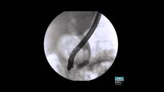 Endoscopic partial sphincterotomy coupled with large balloon papilla dilation [upl. by Sansone952]