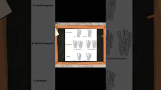 Classification of Lisfranc Injuries lisfranc ortholectures orthopaedics orthodoc ortho [upl. by Okikuy]