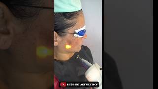 Laser Treatment At Shobhit Aesthetics [upl. by Gladstone]