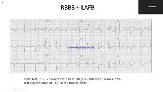 Intraventricular Conduction Defect [upl. by Elhsa167]