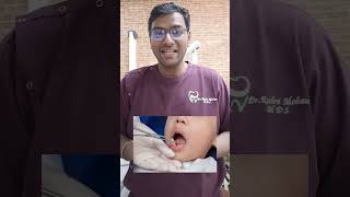 Dr Rudra pulpectomy pediatricdentistry drrudrasdentalcare dentalcare toothpainrelief shorts [upl. by Halonna]