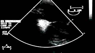 Detection of Patent Foramen Ovale Using Contrast Transesophageal Echocardiography [upl. by Nakre752]