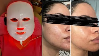 Before and After The Real Effects of Red Light Therapy on Skin [upl. by Ahsratal572]