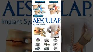 Aesculap activL Artificial Disc Revolutionary Motion Preservation for Degenerative Disc Disease [upl. by Aria]