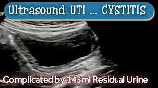 Cystitis  UTI  Ultrasound  Diagnosis [upl. by Nyrtak]