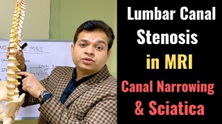 Secondary Canal Stenosis Foraminal Stenosis Stenosis of the Spine in MRI Sciatica MRI PART 2 [upl. by Ferd950]