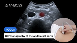 Point of Care Ultrasound of the Abdominal Aorta  AMBOSS Video [upl. by Nohsid]