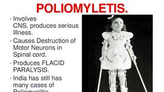 Polio Epidemiology [upl. by Godderd]