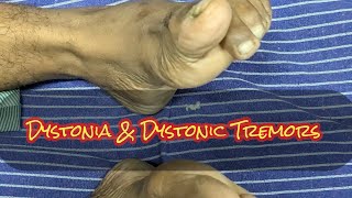 Dystonia Dystonic Tremors Extrapyramidal manifestations STRIATAL TOE [upl. by Perni227]