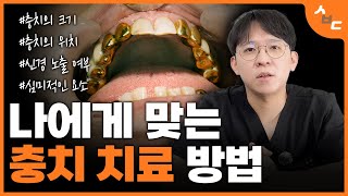 나는 레진하고 싶은데 꼭 크라운을 해야 하나요 레진인레이크라운 그 오묘함 [upl. by Adnahcir908]