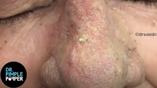 OVER 8 Minutes of SATISFYING Soft Pops Dr Pimple Popper [upl. by Eikceb]