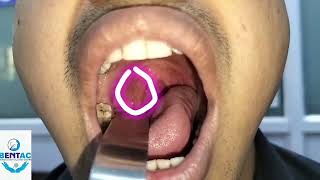 Tonsillolith or Tonsil stone removal tonsilstones tonsils entsurgeon entsurgeondelhi entdoctor [upl. by Esch]