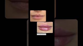 Dudak Dolgusu Lips Filler [upl. by Htehpaj]