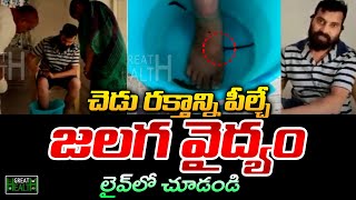 Leech Treatment In Live  Dr Gummadavelli Srinivas  Leech Therapy  Telugu70mm [upl. by Lainey]