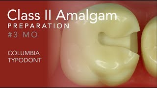 Class II Amalgam Preparation 3 MO [upl. by Thomasina613]