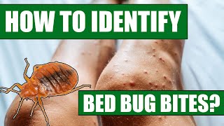 How To Identify Bed Bug Bites  Can Doctors or Exterminators Identify Bed Bug Bites [upl. by Ordnasela]