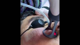 Acne scars treatment by Co2 fractional laser  co2laser  co2fractionallaser  co2  laser [upl. by Iadahs]