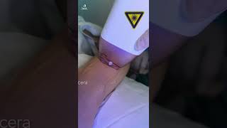 DEPILACIÓN LASER DIODO 4D  MEDICINA ESTÉTICA SER [upl. by Ahsinam]