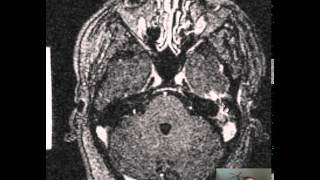 Mastoiditis Brain Abscess DISCUSSION [upl. by Latea575]