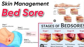 Skin management  Bed Sore amp types  Fundamental of Nursing  Tutor  Hanif khan [upl. by Licna]