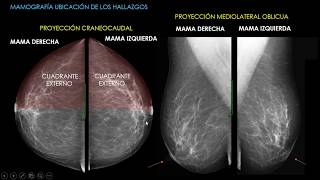 Mamografía Parte 1 [upl. by Laszlo]