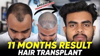 Hair Transplant in India  Best Results amp Cost of Hair Transplant in India [upl. by Aivatahs]