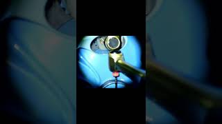 rootcanals retreatment mercury amalgam endodontic kanaltedavisi endodontia [upl. by Bethel]