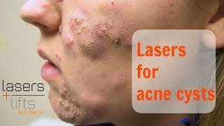 Treating acne cysts [upl. by Toni]