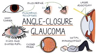 Understanding Acute Angle Closure Glaucoma [upl. by Pierre]