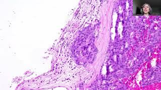 Tip86Atypical Meningioma CNS WHO grade2 [upl. by Khichabia]