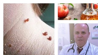 اسرع علاج منزلي طبيعي وفعال للتخلص من الزوائد الجلديه SKIN TAGS REMOVAL [upl. by Ecurb]