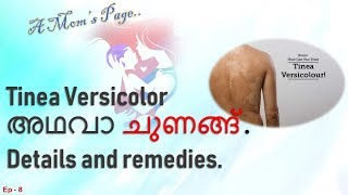 Tinea Versicolor or Pityriasis Versicolor details amp remedies [upl. by Lelah]