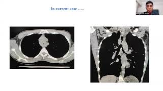 Central Airway Obstruction [upl. by Acnoib]