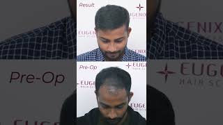 Hair Transplant Before After Your transplanted hair is permanent [upl. by Noied]