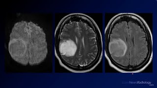 Neuroradiology Board Review  Brain Tumors  Case 2 [upl. by Artenek]