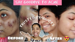 My Acne Transformation Products That Actually Work [upl. by Tybie]