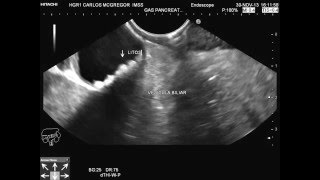 Microlitiasis Vesicular diagnosticada por medio de Ultrasonido Endoscópico [upl. by Arabella]