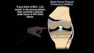 Distal Femur Physeal Fracture  Everything You Need To Know  Dr Nabil Ebraheim [upl. by Emmalee]