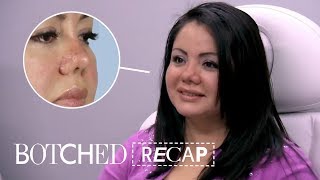 Lipo Patient Gets Surprise Piggy Nose Instead  Botched Recap S5 E10  E [upl. by Noraha966]