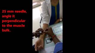 Dry Needling Flexor Pollicis longus [upl. by Ztirf]