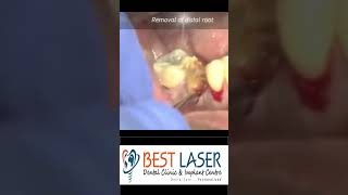 Grossly decayed molar extraction in 30 sec [upl. by Koller278]