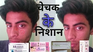 How to remove chicken pox scars spotsचेचक के दाग कैसे हटाये ।। hindi [upl. by Dlarej389]