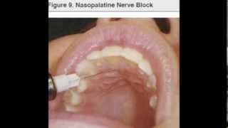 NP nasopalatine nerve block [upl. by Mapes216]