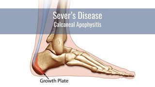 5 Tips For Helping A Child With Severes Disease Calcaneal Apophysitis [upl. by Laeno]