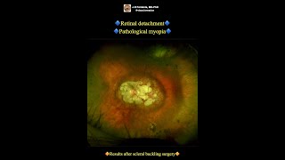 Retinal detachment Pathological myopia Scleral buckling surgery [upl. by Marji]