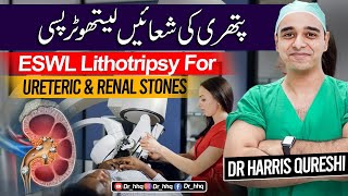 ESWL treatment for kidney stones II گردے کی پتھری کا علاج شاک ویو II Urdu Hindi [upl. by Einnol]