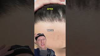 How I Got An INCREDIBLE Hairline Lowering Result [upl. by Mali980]