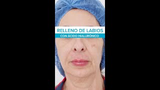 Relleno de labios con ácido hialurónico [upl. by Notnyw26]