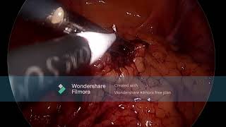 LAPAROSCOPIC APPENDECTOMY [upl. by Georgianna871]