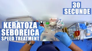 KERATOZA SEBOREICA in 30 de secunde  speed treatment [upl. by Ecirtra]